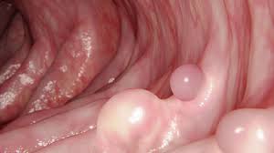 They may look like a patch or a lump or look like an ulcer. How Does Colon Cancer Start Youtube