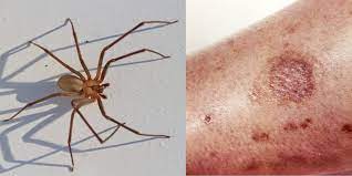 The bite is described as feeling like a pinprick, though hours after being bitten by the black widow spider, the bite injury will swell. How To Treat A Spider Bite What Spiders Bites Are The Most Dangerous