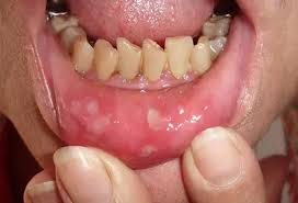 Image result for Hand foot and mouth disease HFMD roof of mouth