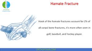 Image result for Hamate Bone