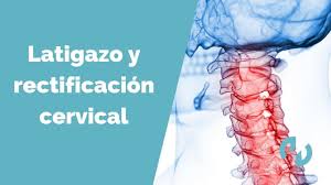 ¿cuáles son las causas y síntomas de una contractura cervical? Latigazo Cervical Y Rectificacion De La Lordosis Cervical