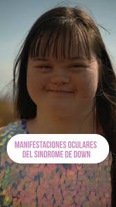 El síndrome de Down se debe a una alteración genética que se produce por la  presencia de un cromosoma extra; de tal modo que las personas con síndrome  de Down tienen 3 copias del cromosoma 21, en ...