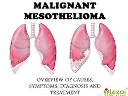 We did not find results for: Malignant Mesothelioma Overview Of Symptoms Diagnosis And Treatment By Lazoithelife Issuu