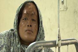 Scarred by acid in Bangladesh