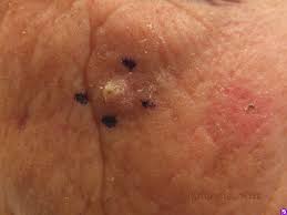 In more complicated cases, a multidisciplinary team of doctors will meet with a patient to discuss different types of treatments to develop a plan with the best chances of curing or controlling this disease (see types of treatment ). Disease Management Nonmelanoma Skin Cancer