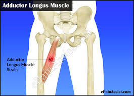 What are the symptoms of groin strain? Adductor Longus Strain Causes Symptoms Treatment