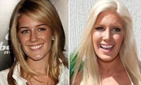 Surgery may be necessary to remove. Can Too Much Plastic Surgery Change Your Personality Excessive Cosmetic Procedures Could Lead To Identity Crisis Warn Psychologists Daily Mail Online