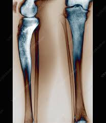 Image result for Osteomyelitis