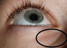 Komische Weisse Punkte Am Auge Was Ist Das Augen