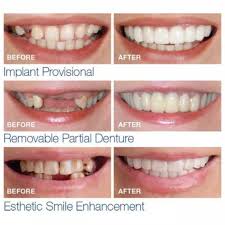 Untuk mengetahui info lebih lengkap mulai dari manfaat, resiko hingga berapa harga gigi palsu permanen, simak info di bawah ini ya. Gigi Palsu Instan Snap On Perfect Smile Sepasang Atas Bawah Shopee Indonesia