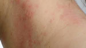 Contact dermatitis usually shows up when you've been touched by a substance that triggers a reaction, like poison ivy dry skin with a glazed, parched aspect is often the first sign with irritants. Contact Dermatitis Causes Symptoms And Treatment