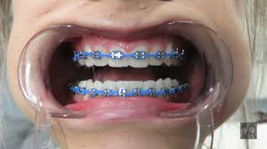 Black And Light Blue Braces Pin By Kiyaabraham On Braces Tips Braces Colors Cute Braces Cute Braces Colors