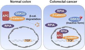 You may have a melanoma on your skin, and if we catch it early and get it off, that may be the end of it. Identification Of A Noncanonical Function For Ribose 5 Phosphate Isomerase A Promotes Colorectal Cancer Formation By Stabilizing And Activating B Catenin Via A Novel C Terminal Domain
