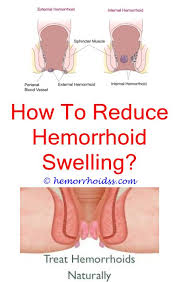 Pin On Hemorrhoid Relief