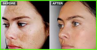 Top 11 Creams For Dark Spots Available In India 2021