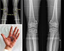 X Beine Behandlung Und Korrektur Schulthess Klinik
