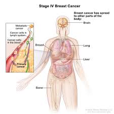 Metastasis occurs during stage 4 cancer, but it can happen any time from when a person first becomes aware that they have. Cancerhelp Online Nci Cancer Diagnosis And Treatment