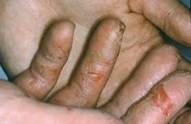 34 yrs old male asked about skin pleening, 1 doctor answered this and 25 people found it useful. Hand Eczema National Eczema Association