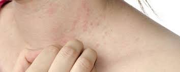 Even with treatment, signs can last two to four weeks. Skin Rashes Healthengine Blog