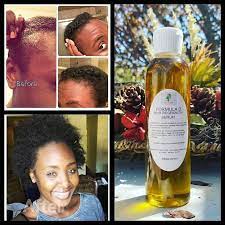It also contains saw palmetto that helps prevent dht production. Kit Formula D Hair Re Growth Oil Serum Shampoo Dht Blocker Hair Loss Treatment For Men Or Women Alopecia Natural Hair Black Castor Oil