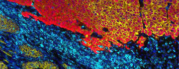 Scientists find possible cause of 'aggressiveness' in prostate cancer. New Upseq Test Holds Promise For Detecting Aggressive Prostate Cancer University Of Michigan Rogel Cancer Center