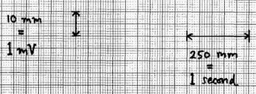 How To Read An Electrocardiogram Ecg Part One Basic