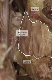 Check spelling or type a new query. Lateral Extent And Ventral Laminar Attachments Of The Lumbar Ligamentum Flavum Cadaveric Study Sciencedirect