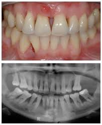 Advance white, essentials, complete care, sensitive teeth & gums Rebuilding Bone Loss In Gums Blog Advanced Dentistry