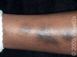 Image result for Pigment stains on the shin