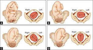Image result for Manual Rotation in Occipitoposterior Presentation