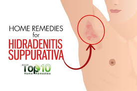 Home Remedies For Hidradenitis Suppurativa Top 10 Home Remedies Hidradenitis Suppurativa Remedies Acne Inversa Home Remedies