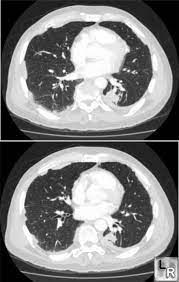 Learningradiology Rounded Atelectasis Round Radiology Imaging Radiology Nuclear Medicine