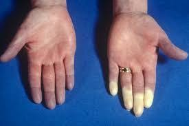 Raynaud Hastaligi Nedir Neden Olur Belirtileri Ve Tedavisi Kan Damarlari