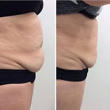 Cryodefine Fat Freezing Available At Australian Skin Clinics