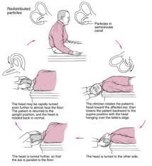 Are Crystals In My Ears Causing My Dizziness Everyday Hearing Epley Maneuver Vertigo Treatment Vertigo