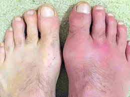 I fans agiscono infatti riducendo. Come Curare La Gotta Guerra All Iperuricemia Assocarenews It Quotidiano Sanitario Nazionale
