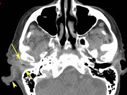 Image result for Necrotizing Otitis Externa