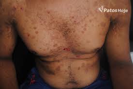 A paradigm of human autoimmunity. Jovem Com Fogo Selvagem Conta Historia Dramatica E Pede Ajuda Da Populacao Patense