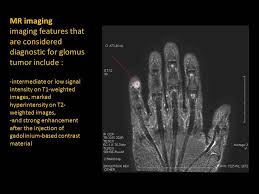 Image result for Glomus tumor