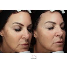 💉 Say goodbye to the double chin with Kybella! This non-surgical,  FDA-approved treatment targets and destroys fat cells beneath the chin,  giving you a more defined, contoured jawline. ✨ ✨ After your