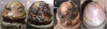 Image result for balanoposthitis