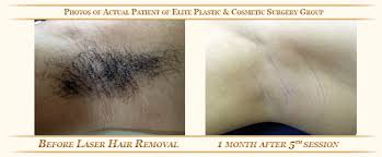 Laser hair removal does a great job in eliminating and preventing ingrown hairs. Laser Hair Removal Treatment Dubai Uae Best Plastic Cosmetic Surgery Clinic Dubai Uae