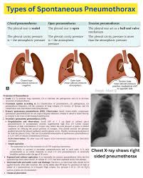 Image result for Pneumothorax