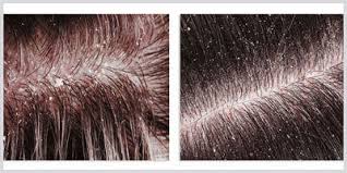 Shop with afterpay on eligible items. Alpecin The Expert For Hair Loss Scalp Problems