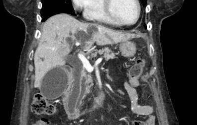 Corte Tomográfico Coronal Mostrando La Dilatación Biliar Y Distensión Vesicular Por Masa Periampular, Generada Por Ia