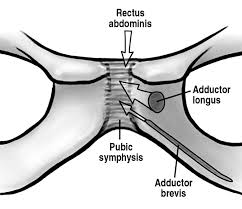 Image result for Pubic Apophysitis