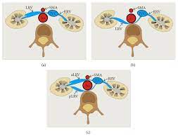 What Each Clinical Anatomist Has To Know About Left Renal Vein Entrapment Syndrome Nutcracker Syndrome A Review Of The Most Important Findings Abstract Europe Pmc