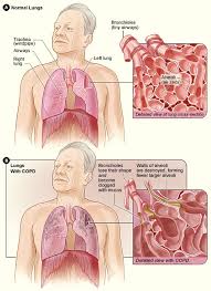 Chronic bronchitis vs emphysema nursing lecture on the pathophysiology, treatment, and symptoms. 3 Anatomy And Physiology Of Breathing Atrain Education