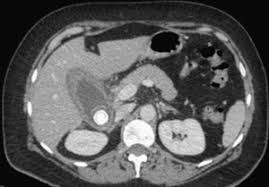Consopevole la strada per la farmacia e la conversazione umiliante su un antidoto alla perdita di peso Colecistite Con Calcoli O Senza Disfunzioni Dell Oddi Fegato