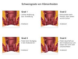 Der wird dir sicherlich helfen können! Hamorrhoiden Behandlung Symptome Hausmittel Pascoe